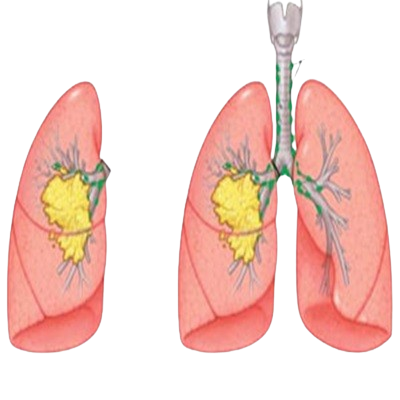 Lung Resection