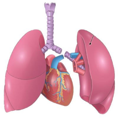 Lung Transplant