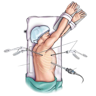 Video-assisted_Thoracoscopic-Surgery-VATS