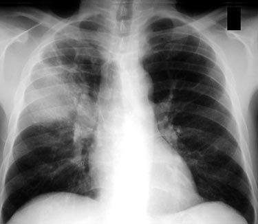 Representative chest imaging for pulmonary disease assessment