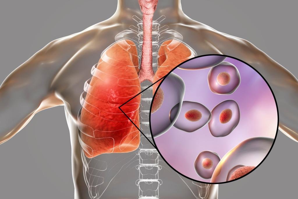 Medical illustration representing HIV-related lung disease